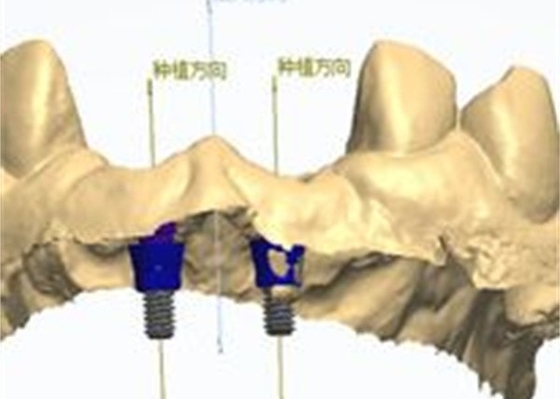 Conception CAD/CAM précise de couronne dentaire en zirconium pour l'ajustement