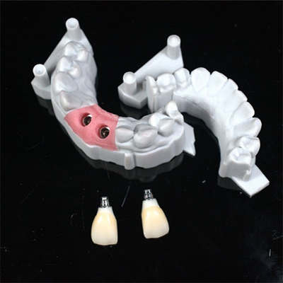 Conception CAD/CAM précise de couronne dentaire en zirconium pour l'ajustement