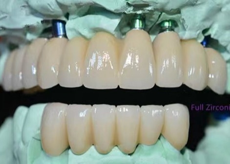OEM Implant Zirconia Couronne dentaire pont fixe