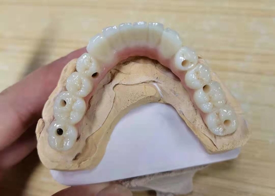 La couronne en zirconium avec dentition implantée pour laboratoire dentaire