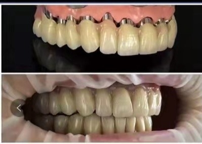 La couronne télescopique 3D dentaire de pont en couronne d'implant du DAO FAO PFM a imprimé des modèles