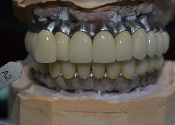 Satisfaction patiente de donner la priorité notre engagement aux couronnes d'implant dentaire de qualité