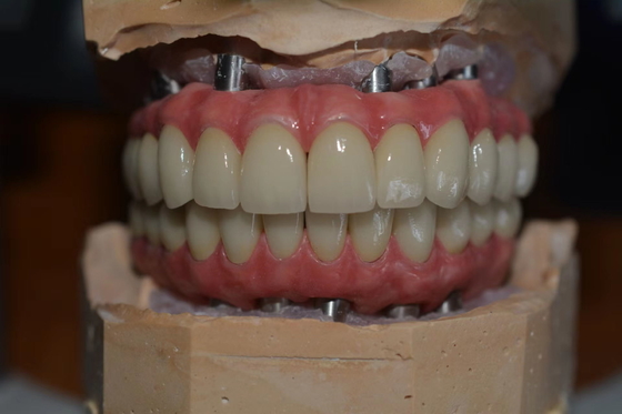 Des couronnes d'implants dentaires de précision pour le confort et la confiance