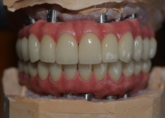 Satisfaction patiente de donner la priorité notre engagement aux couronnes d'implant dentaire de qualité
