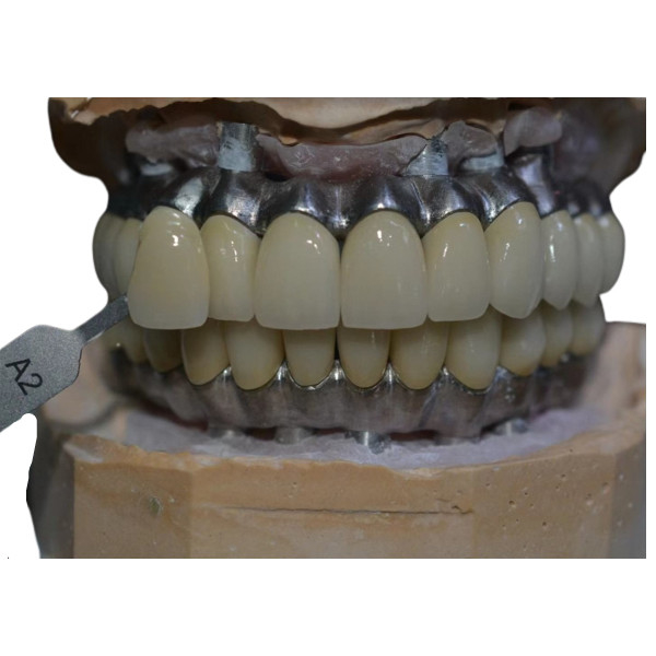 Matériel biologique de couronne soutenu par implant anticorrosion en métal de Cr de Co