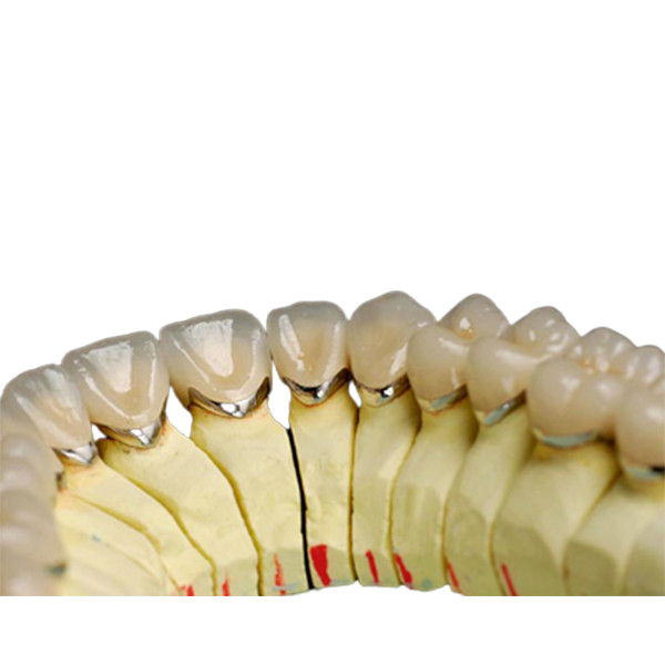 Dent naturelle de porcelaine en métal de laboratoire d'alliage de couronne dentaire titanique dentaire de porcelaine