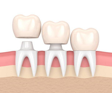 Couleur stable de couleur de Porcelai CrownRealistic non facile de casser la porcelaine