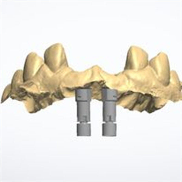 Une couronne en zirconium 3D personnalisée offrant une durabilité durable conçue pour répondre aux besoins des professionnels dentaires et des laboratoires